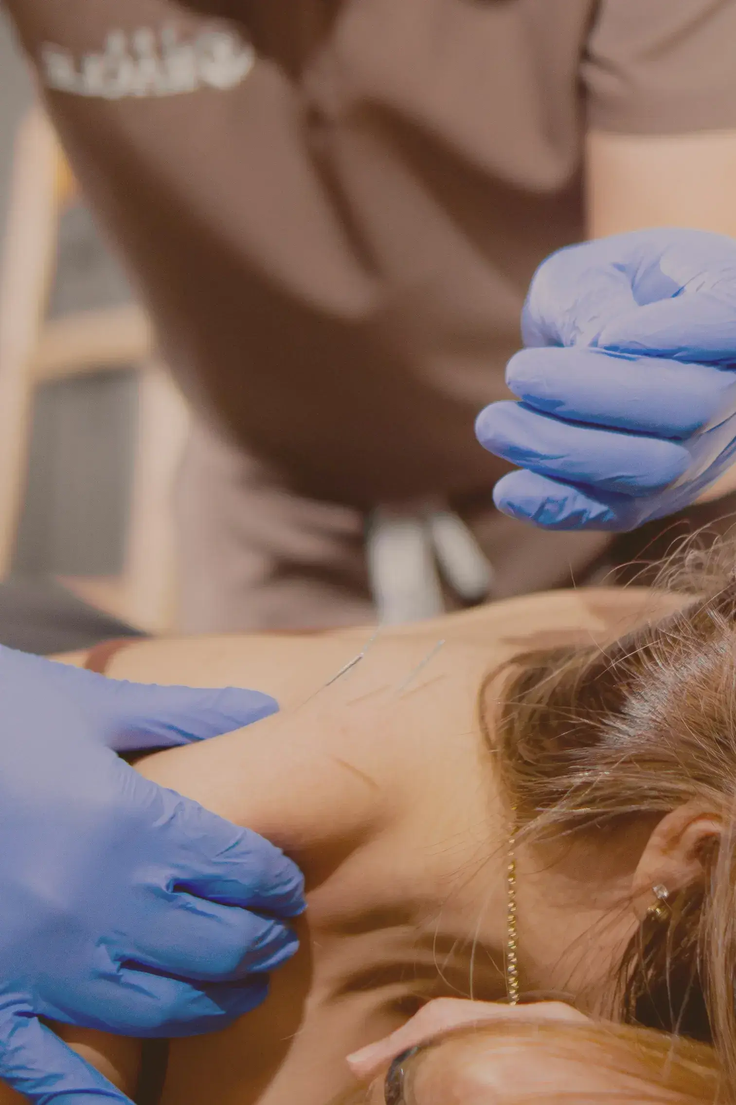 Close up of practitioner in blue gloves inserting acupuncture needles into a patient shoulder and upper back.
