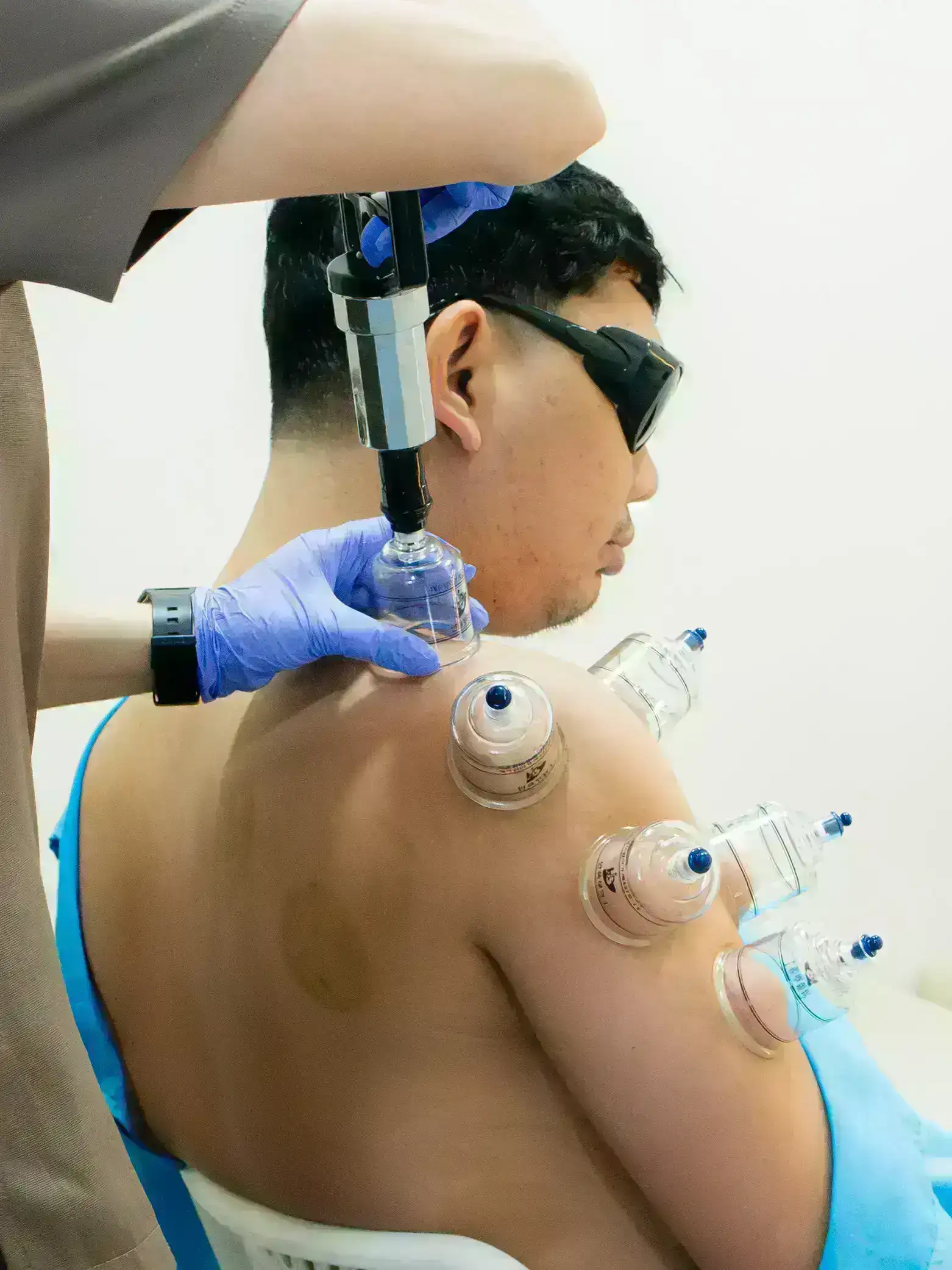 Man receiving cupping therapy on his shoulder with multiple clear suction cups while a practitioner in gloves operates a handheld pump.